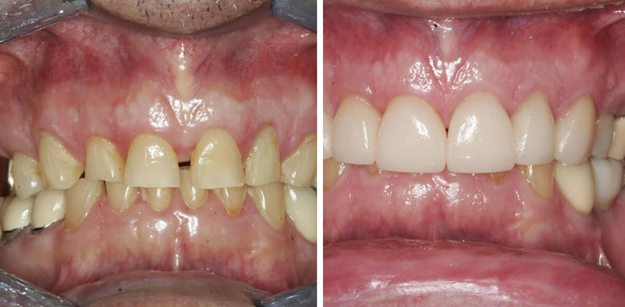 a patient's mouth before and after cosmetic treatment
