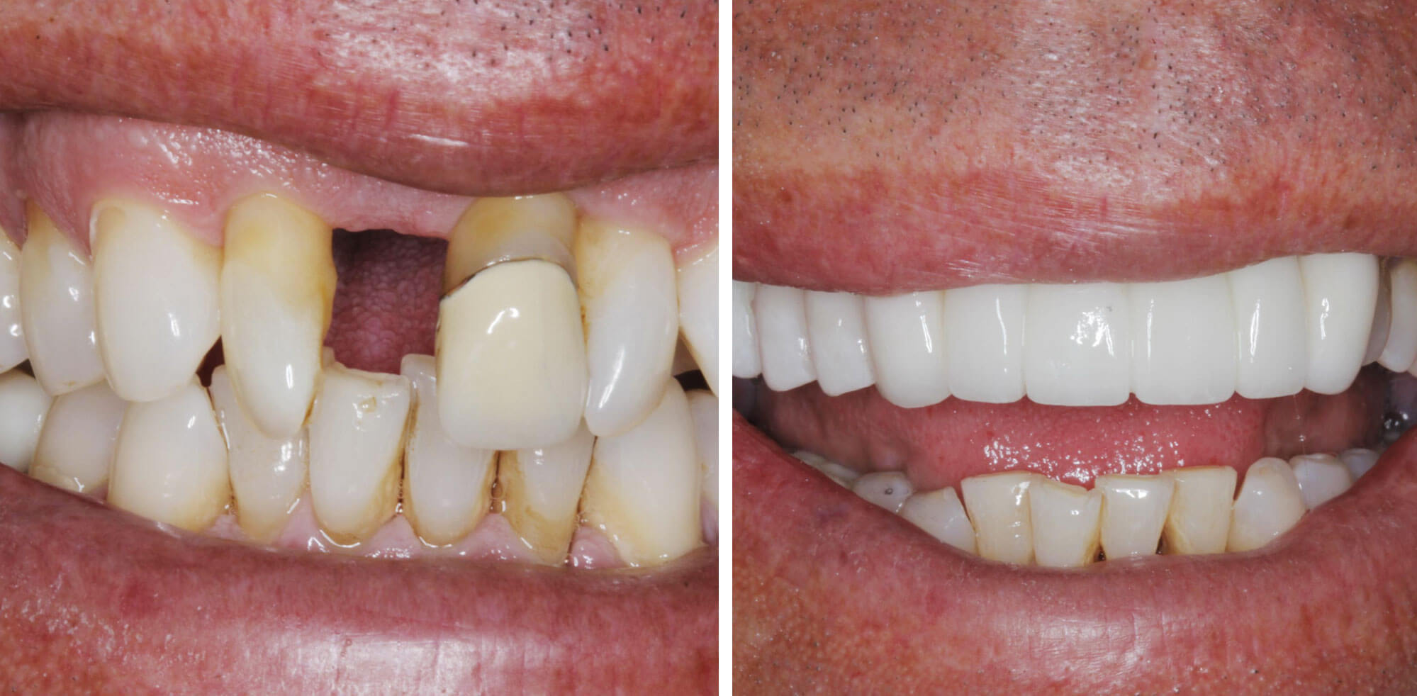 image of a patient's smile before and after their makeover
