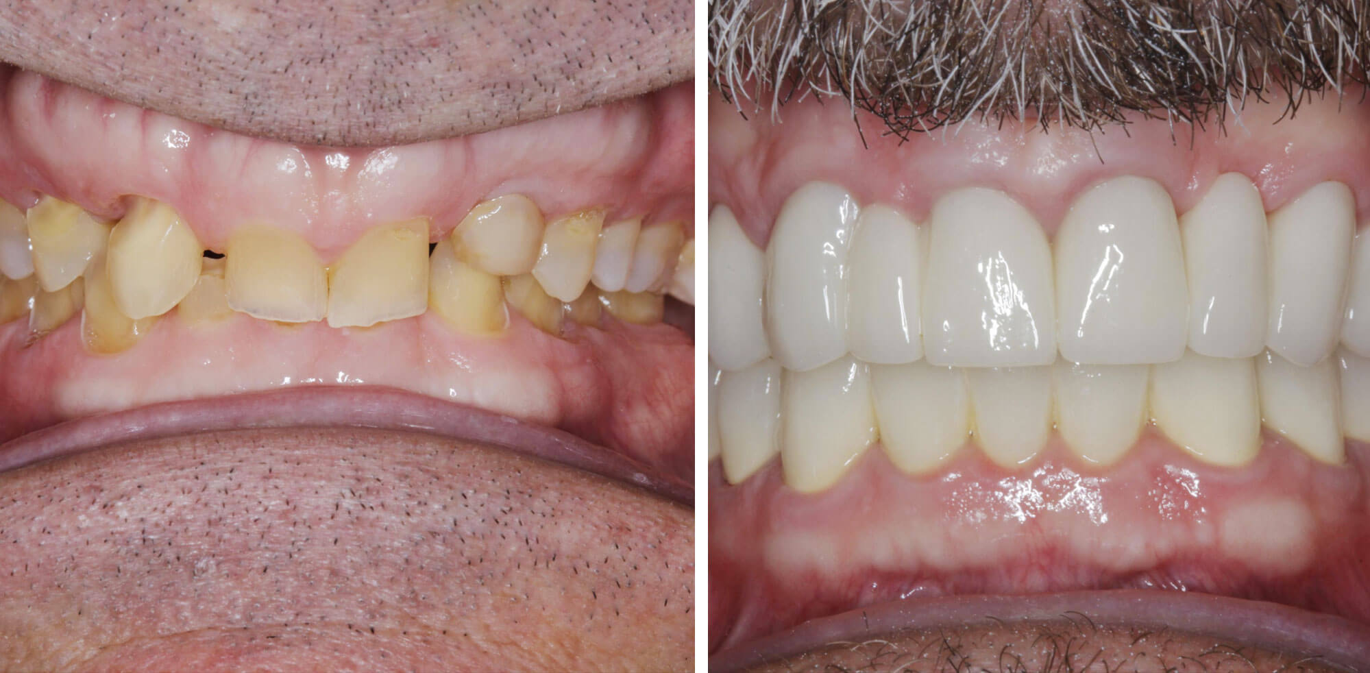 a man's smile before and after his smile makeover