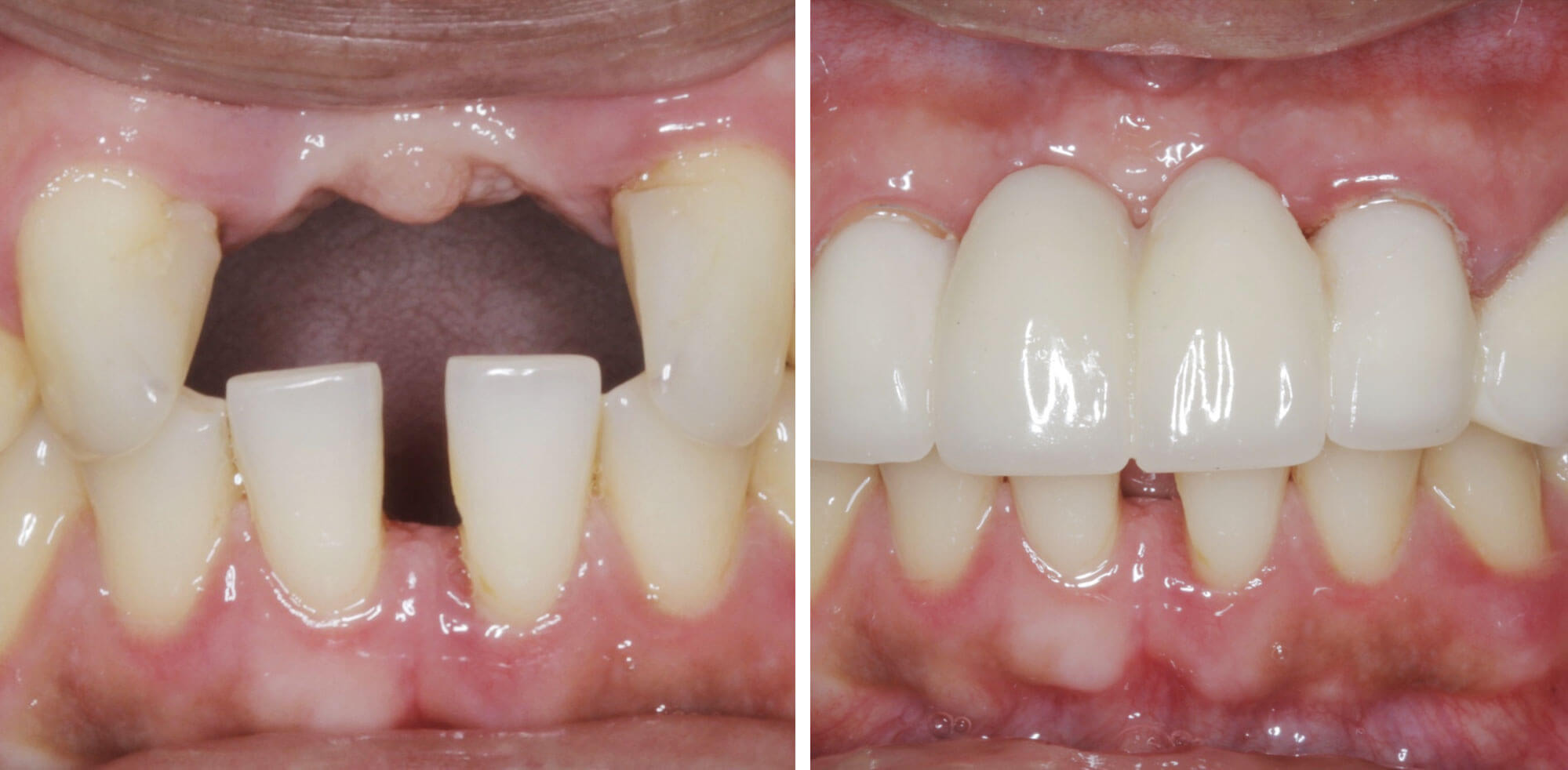 image of a patient's smile before and after tooth replacement