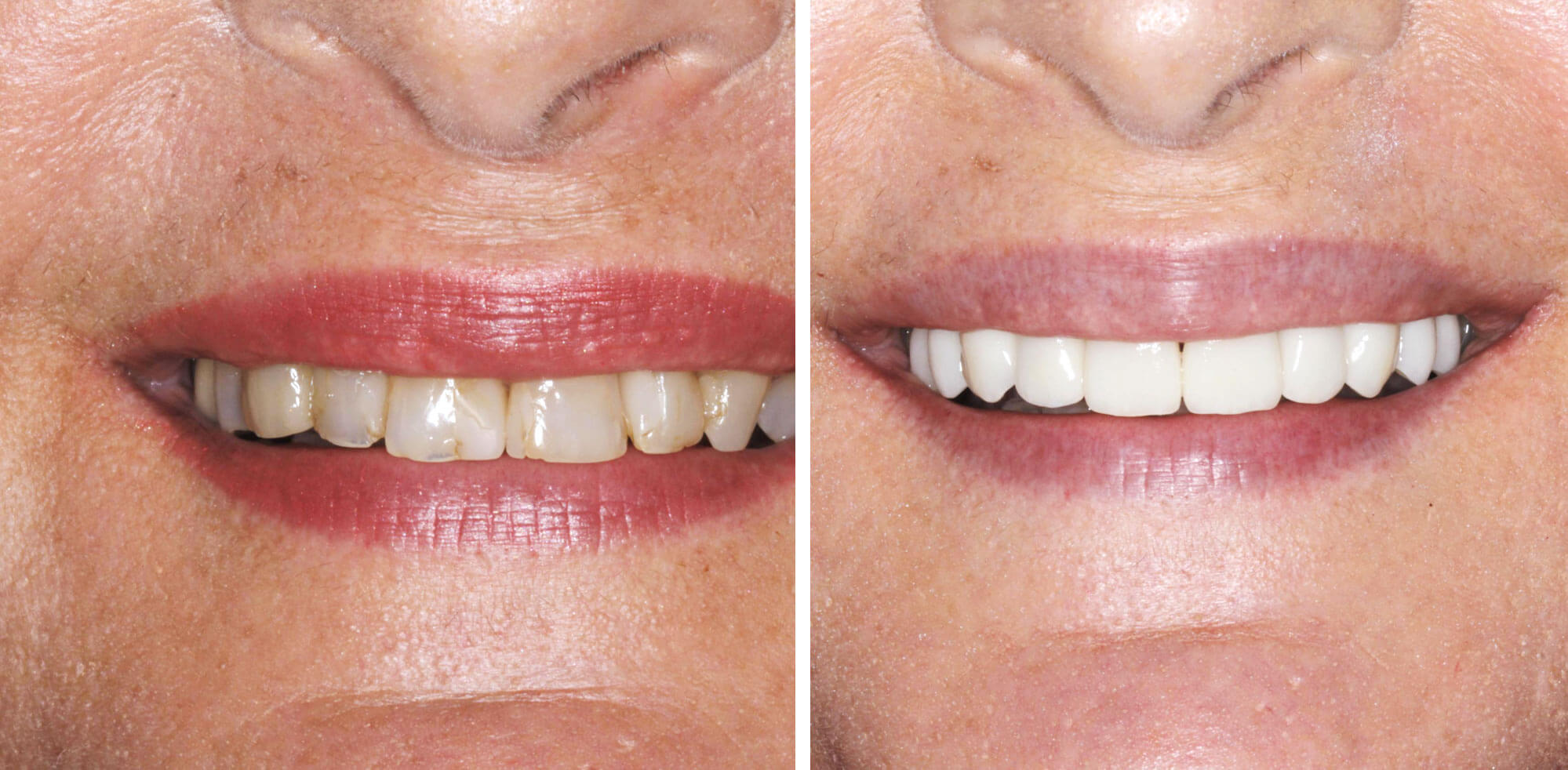a woman's smile before and after treatment
