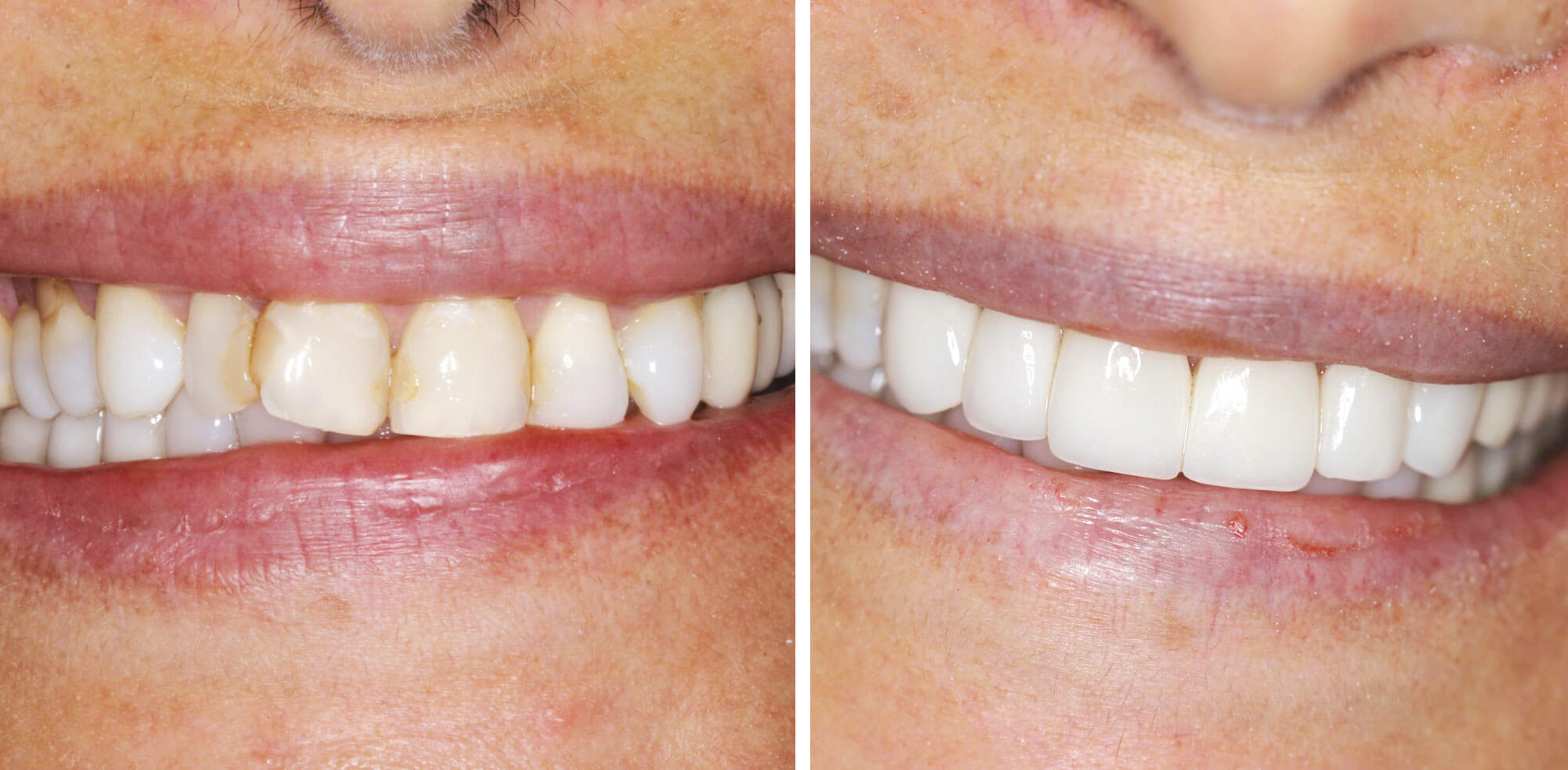 patient's smile before and after their smile makeover