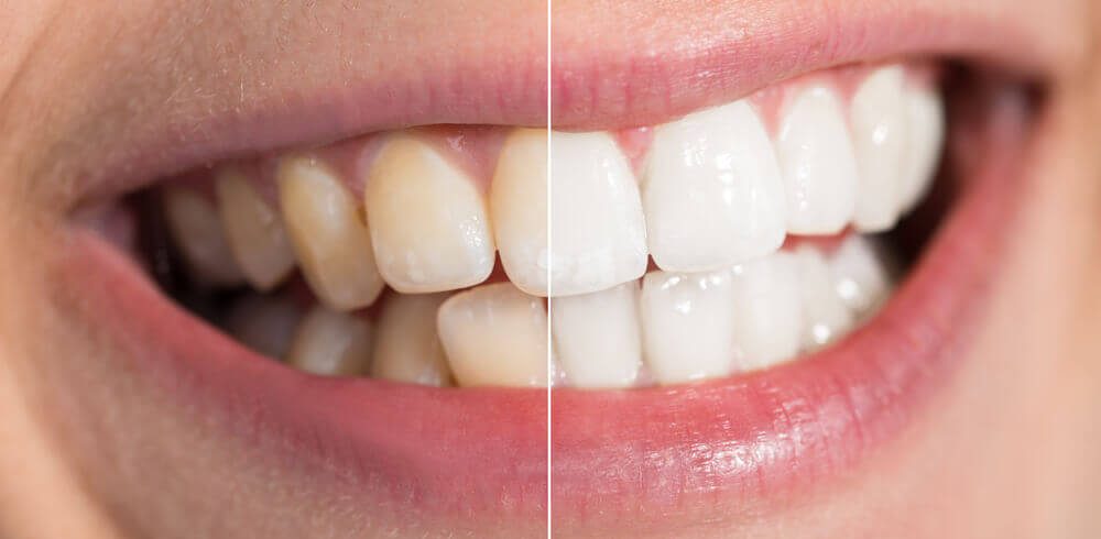 image of a patient's smile demonstrating the difference of whitening
